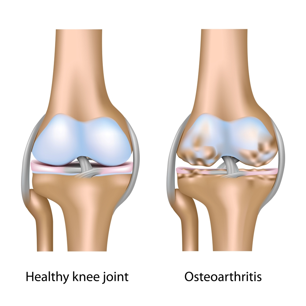 Knee Arthritis AOTS