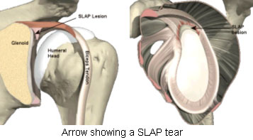 SLAP tears diagram