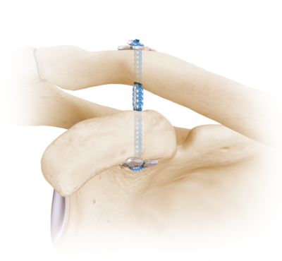Acromioclavicular Joint Reconstruction All Arthroscopic Adelaide