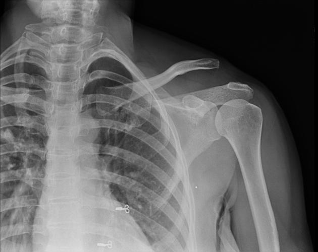 Acromioclavicular Joint Dislocation Xray Adelaide