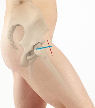 The Bikini Incision For Anterior Approach Total Hip Arthroplasty My