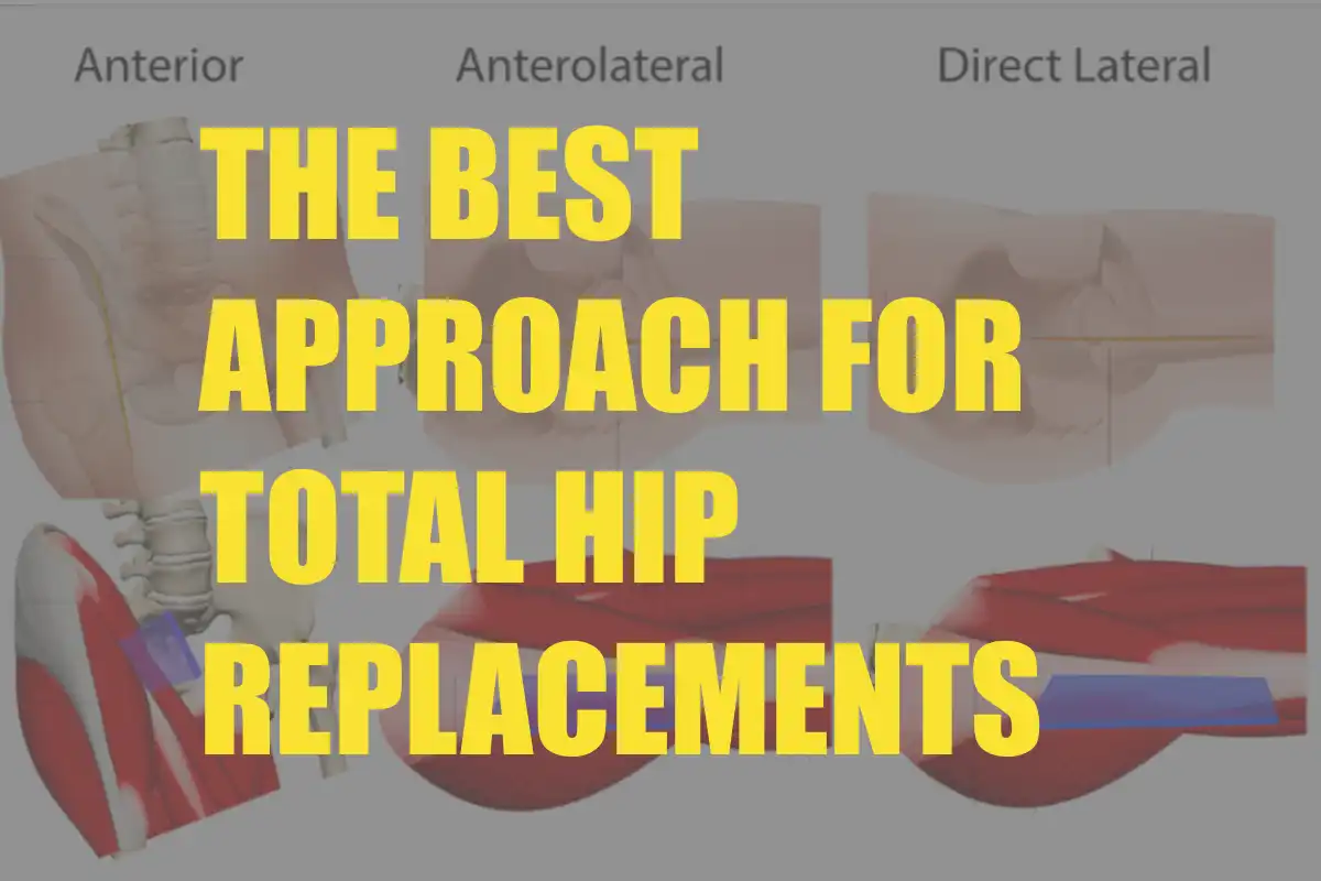 Difference Between Lateral and Anterior Hip Replacement