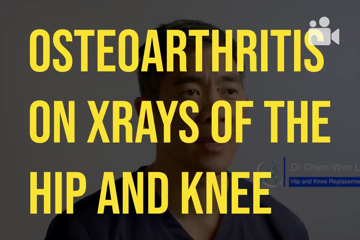 osteoarthritis-on-hip-and-knee-xrays-dr-chien-wen-liew